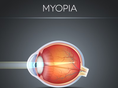 Myopia Control